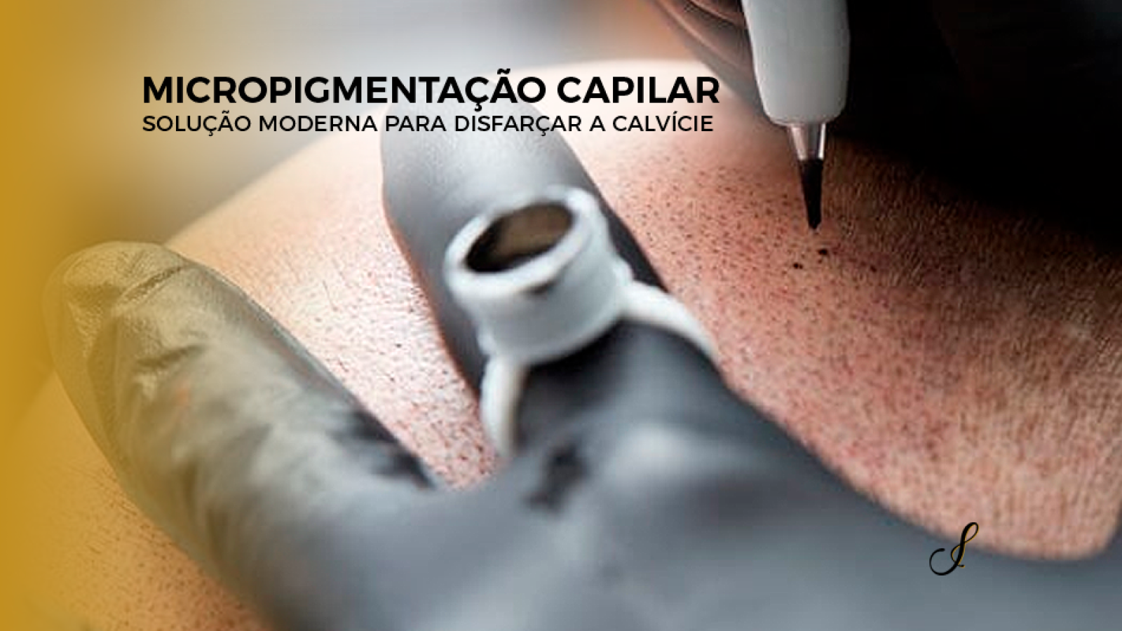 micropigmentacao-capilar-solucao-moderna-para-disfarcar-a-calvicie-img-blog