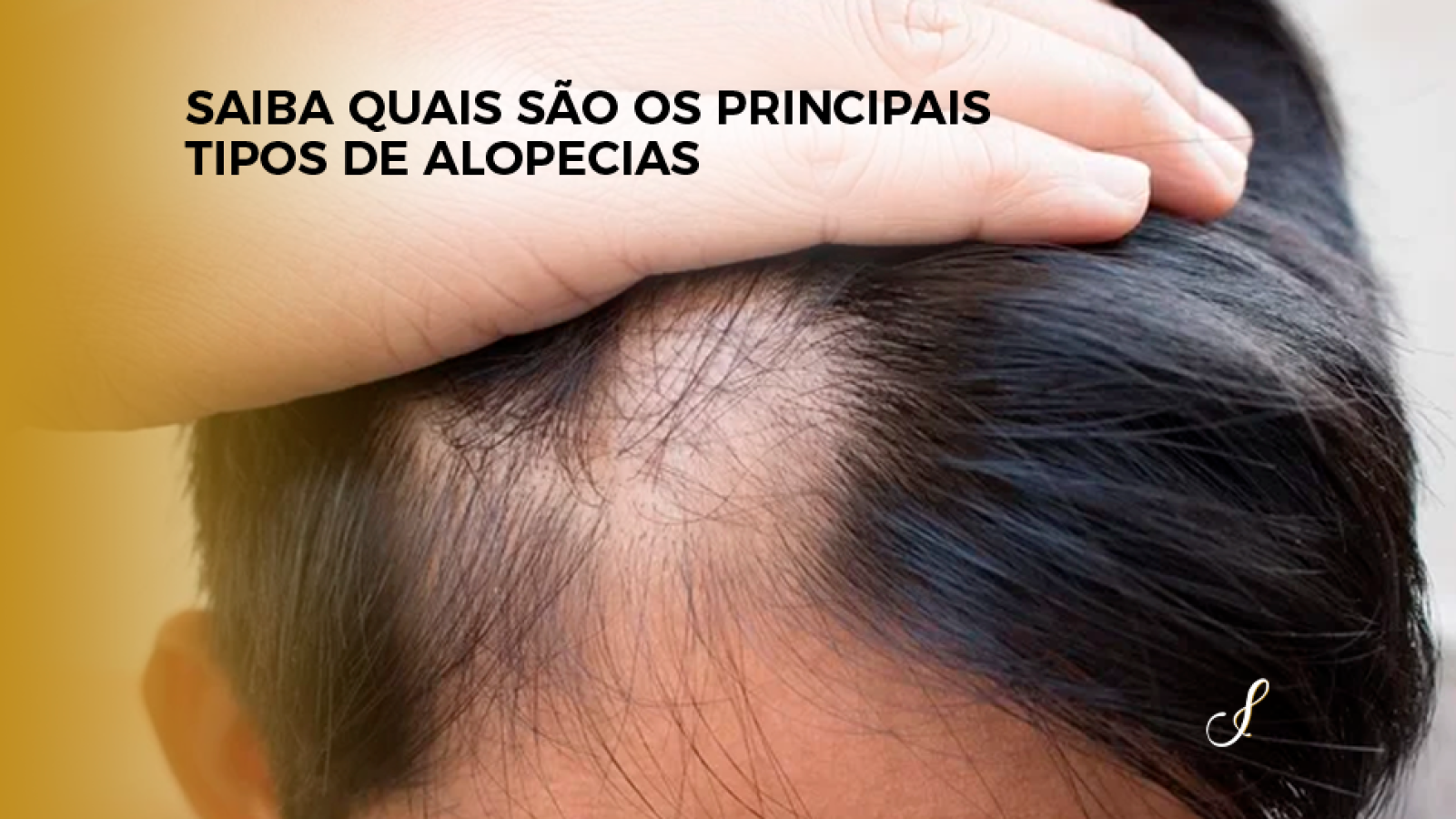 Capa - Saiba Quais São os Principais Tipos de Alopecias