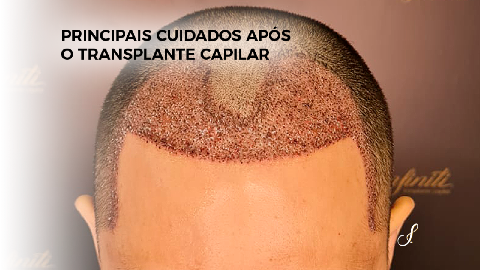 Principais Cuidados Após o Transplante Capilar