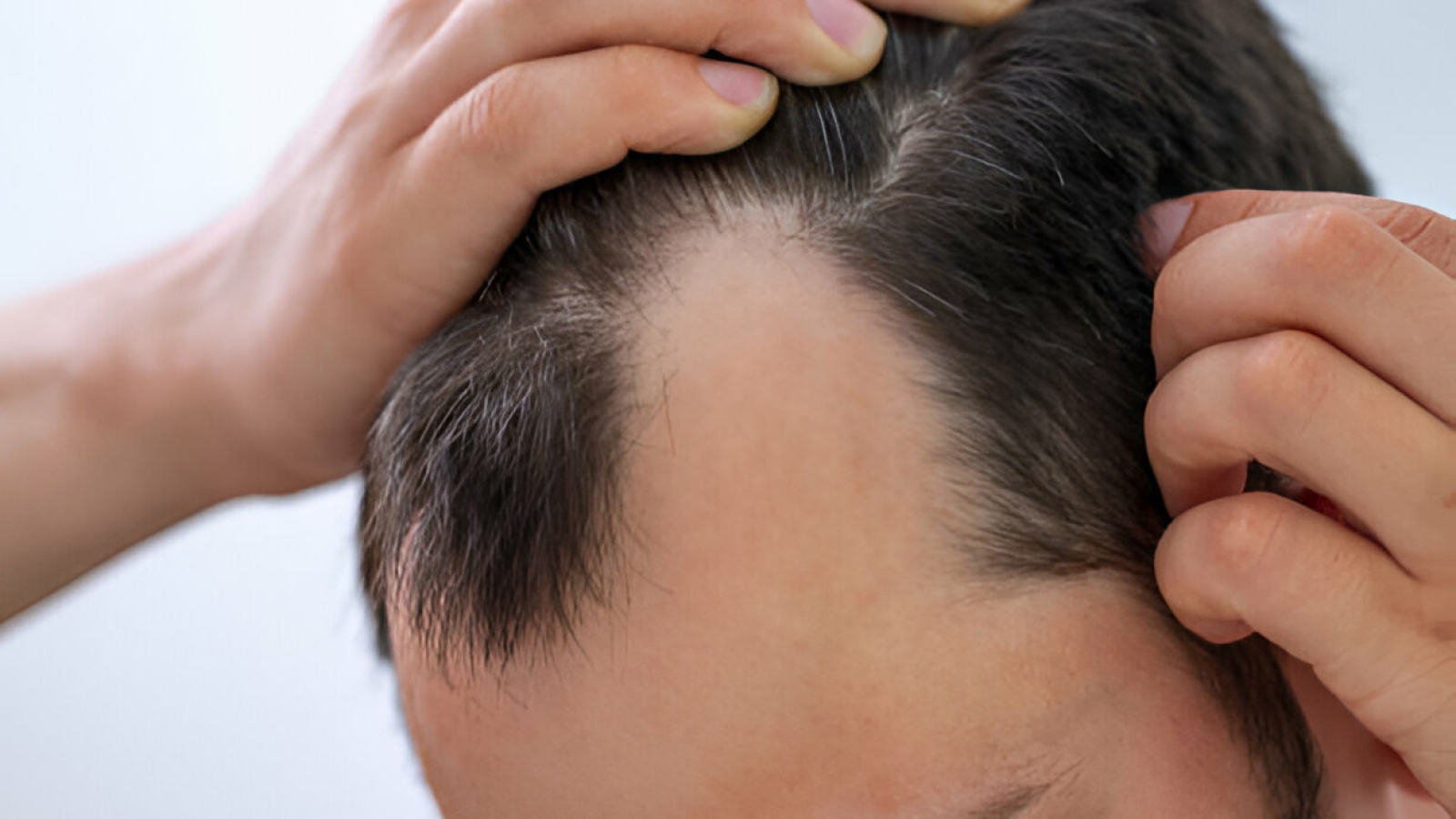 Por que o Planejamento Pré-Transplante Capilar é Importante?